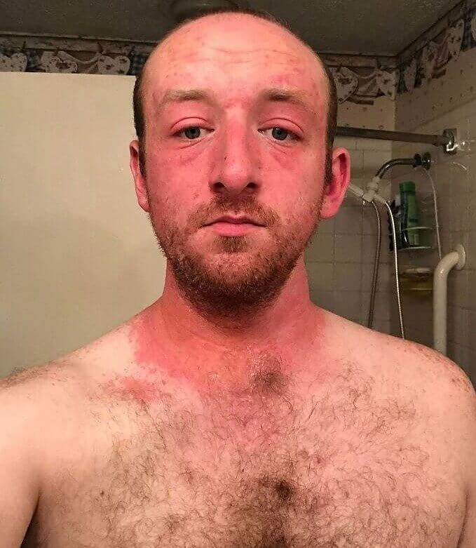 When You Don't Know What Poison Ivy Looks Like