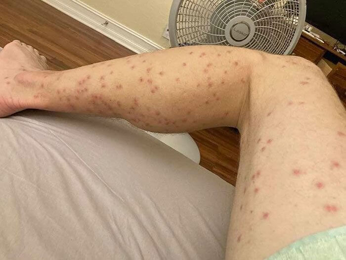 When the Mosquitos Love You Too Much